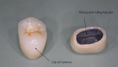 bọc răng sứ kim loại