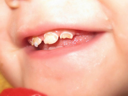 Viêm Chân Răng Ở Trẻ Em