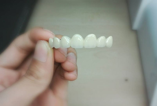 bọc răng sứ giá bao nhiêu
