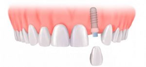 Cắm implant răng cửa được thực hiện thế nào? 2