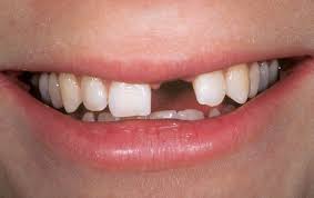 Cắm implant răng cửa được thực hiện thế nào? 1