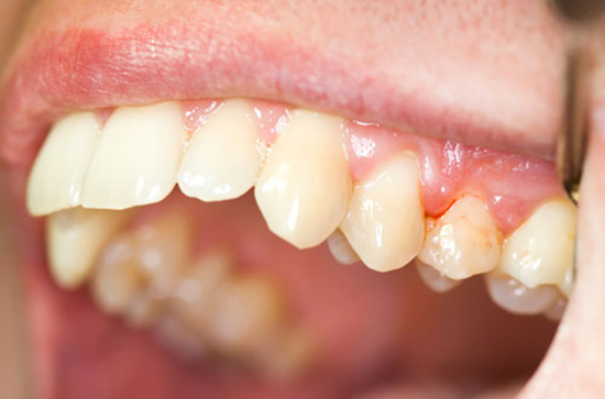 cạo vôi răng có tác dụng gì