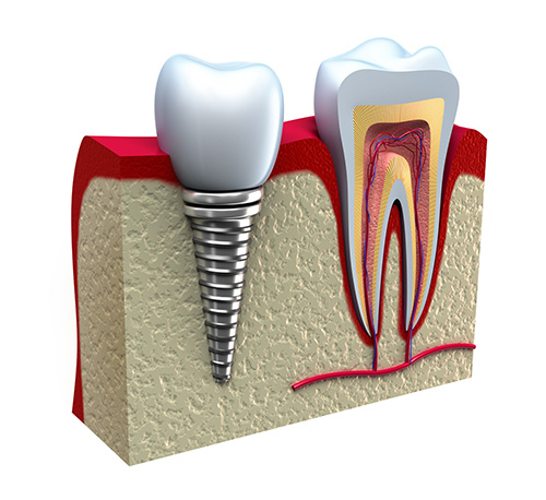 cấy ghép implant cho răng cửa