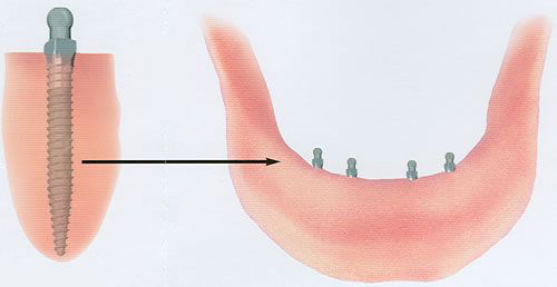 cấy ghép răng implant như thế nào