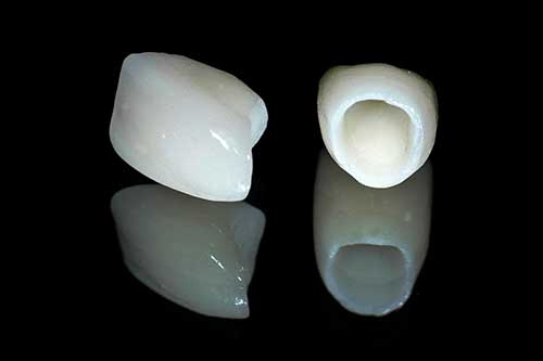 làm trắng răng bị nhiễm tetracycline