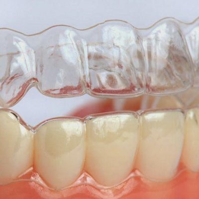 niềng răng không mắc cài 3D Clear