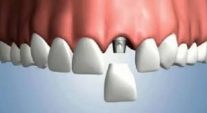 Quy trình cấy ghép implant cho răng cửa 2