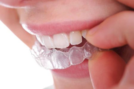 quy trình tẩy trắng răng tại nhà như thế nào