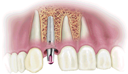 quá trình cấy ghép implant cho răng hàm