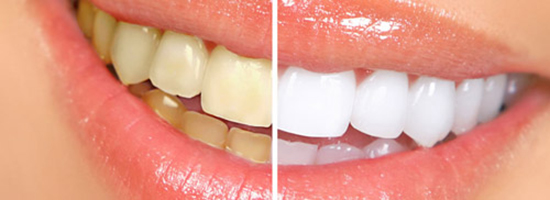 răng bị vàng có tẩy trắng được không