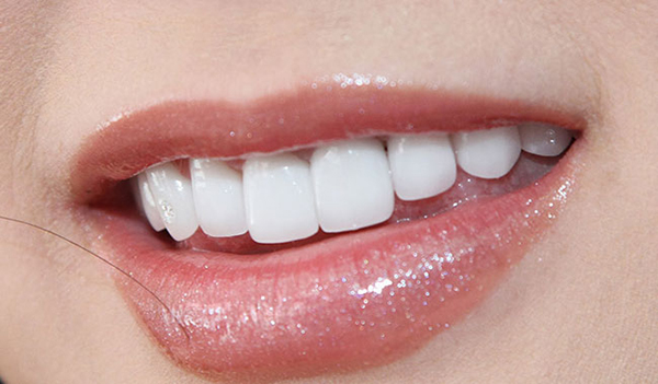 răng sứ kim loại 