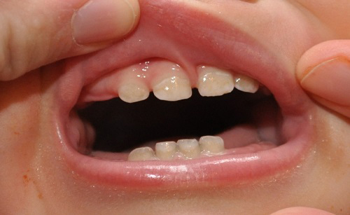 sưng nướu răng ở trẻ em