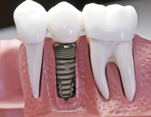 Trồng răng sứ khắc phục mất răng 1