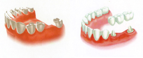 Trồng răng sứ khắc phục mất răng 2