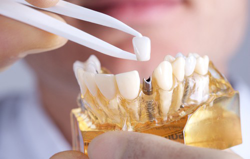 trồng răng implant cố định
