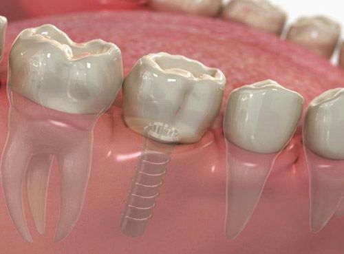 Chi phí cấy ghép răng implant giá bao nhiêu