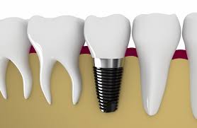 Chăm sóc răng sau khi cấy implant 