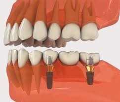 Cấy ghép implant răng hàm được thực hiện thế nào