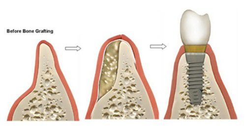 Cấy ghép implant răng hàm được thực hiện thế nào