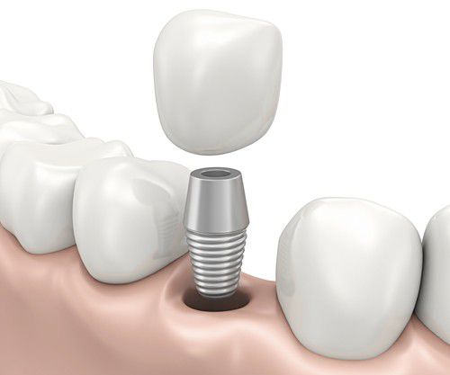 Cấy ghép răng implant tiêu chuẩn quốc tế