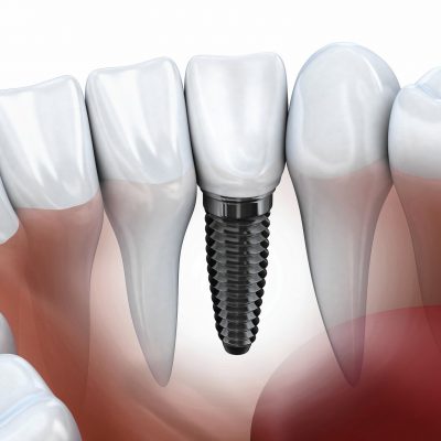 Kỹ thuật làm răng implant có đau không