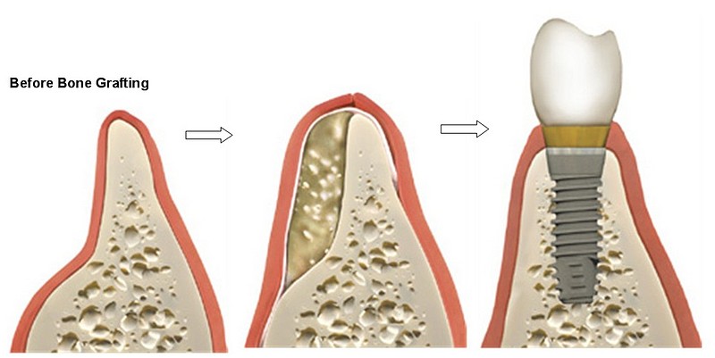 Kỹ thuật làm răng implant có đau không