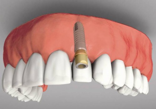 Kỹ thuật trồng răng implant hiên nay như thế nào_