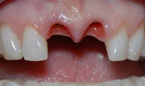 Kỹ thuật trồng răng implant hiên nay như thế nào_
