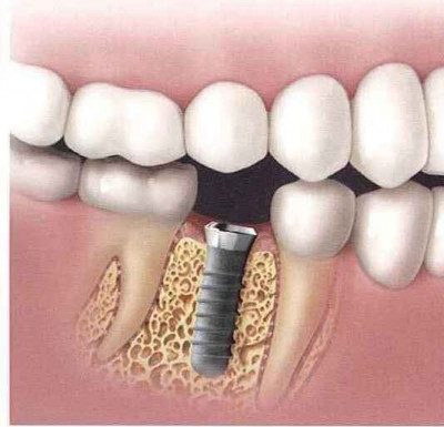 Phương Pháp Cấy Ghép Răng Implant Nha Khoa