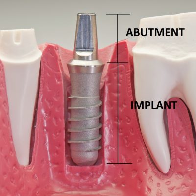 Quy Trình Làm Răng Implant Như Thế Nào_
