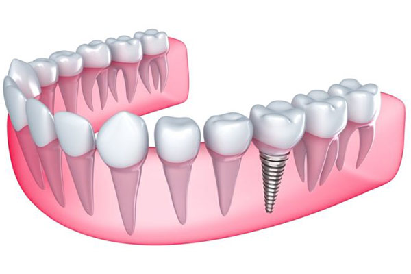 Quy Trình Làm Răng Implant Như Thế Nào_