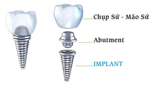 Cấy ghép implant trong nha khoa là gì? 3