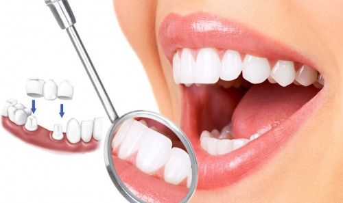 Nên tẩy trắng răng loại nào tốt hiện nay? 3