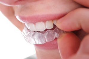 Nên tẩy trắng răng loại nào tốt hiện nay? 2