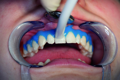 Phương pháp tẩy trắng răng an toàn hiệu quả 2