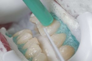 Tại sao ê buốt răng sau khi tẩy trắng? 2