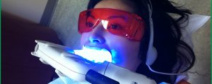 Tẩy trắng răng bằng laser có hại không? 1