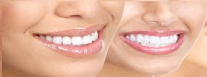 Tẩy trắng răng được bao lâu và cách chăm sóc ra sao? 1