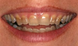 Tẩy trắng răng nhiễm tetra có an toàn không? 1