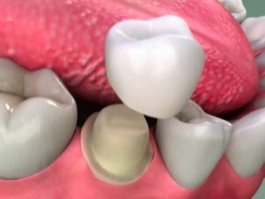 Tẩy trắng răng nhiễm tetra có an toàn không? 2