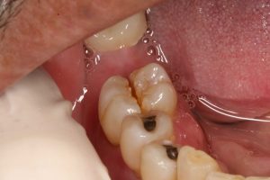 Tẩy trắng răng sâu có an toàn không? 1