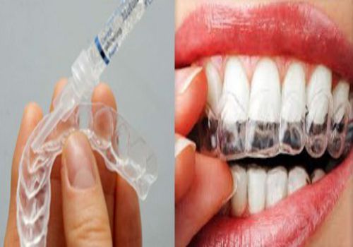 Tẩy trắng răng vĩnh viễn có được không? Có bền lâu không? 2