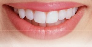 Tẩy trắng răng vĩnh viễn có được không? Có bền lâu không? 1