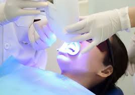 Tẩy trắng răng vĩnh viễn có được không? Có bền lâu không? 3